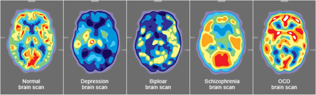 Title: Brain Scans  - Description: Five brain scan images. The first is a normal brain scan, the second is a depression brain scan, the third is bipolar brain scan, the fourth is schizophrenia, and the last is an OCD brain scan. 